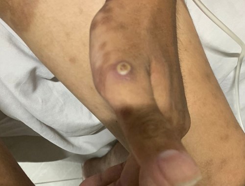Ghi nhận thêm 1 trường hợp mắc bệnh đậu mùa khỉ tại Đồng Nai