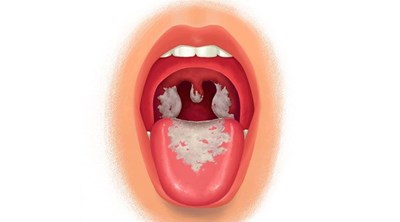 Không chủ quan với bệnh BẠCH HẦU