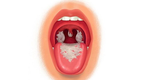 Không chủ quan với bệnh BẠCH HẦU