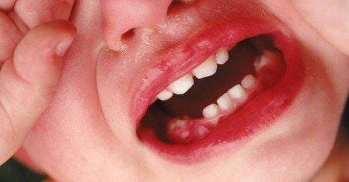 Thiếu Vitamin A,D,E – hậu quả cho bệnh vùng quanh răng
