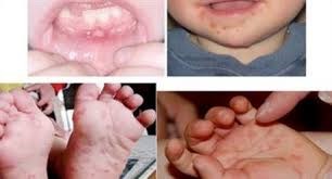 Dấu hiệu cần nhập viện khi trẻ mắc tay chân miệng