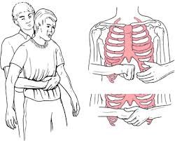 Phương pháp Helmich - SƠ CỨU NHANH KHI TRẺ BỊ HÓC DI VẬT CHA MẸ CẦN BIẾT