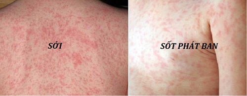 Bệnh sởi - không chỉ là phát ban