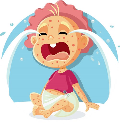 Hỏi đáp về bệnh Sởi