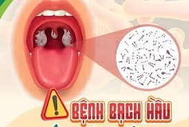 Bệnh bạch hầu: Đặc điểm, nguyên nhân, triệu chứng và cách phòng ngừa