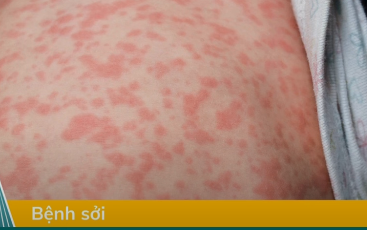Sởi ở trẻ sơ sinh - Nguy hiểm tiềm ẩn và cách phòng ngừa