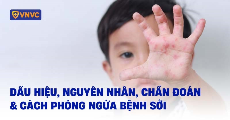 Bệnh sởi: Dấu hiệu, nguyên nhân, chẩn đoán và cách phòng ngừa