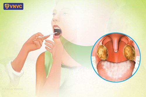 Bệnh bạch hầu: nguyên nhân và triệu chứng nhận biết