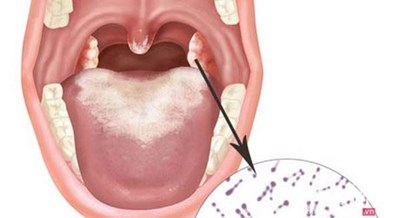Những điều cần biết về bệnh Bạch hầu