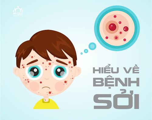 Những điều cần biết về bệnh sởi