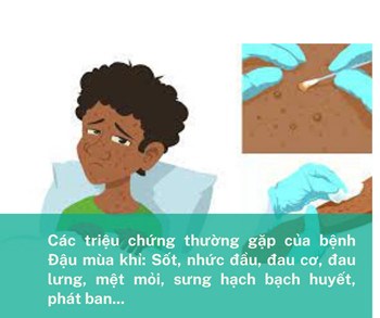 Hỏi đáp về bệnh đầu mùa khỉ