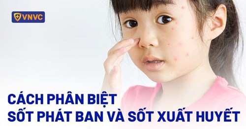 Cách phân biệt sốt ban và sốt xuất huyết