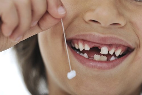 4 biện pháp phòng sún răng cho trẻ cha mẹ cần biết
