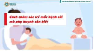 Cách chăm sóc trẻ mắc bệnh sởi mà  phụ huynh cần biết