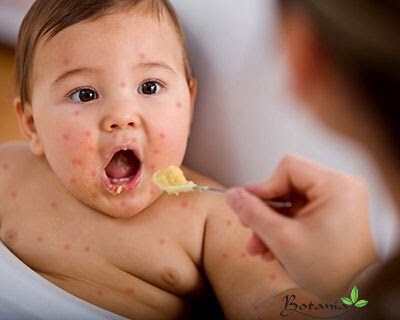 Bệnh Tay Chân Miệng: Dấu hiệu, Cách Chăm Sóc