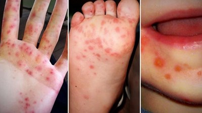 Bệnh Tay Chân Miệng: Nhận diện và chăm sóc trẻ bệnh