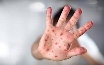 Những Thông Tin và Kiến Thức về Bệnh Tay Chân Miệng