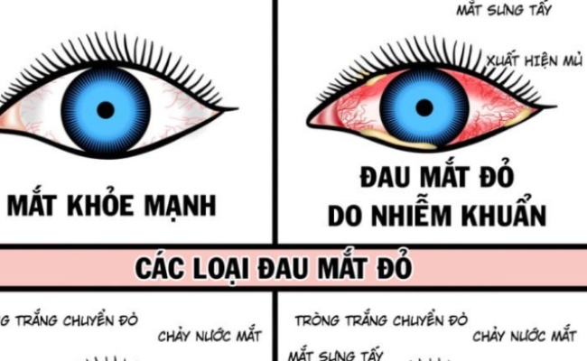 Biện pháp phòng bệnh đau mắt đỏ.