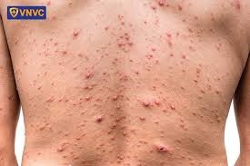 Tiêm vắc xin VARICELLA phòng bệnh thuỷ đậu