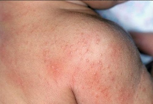 Các bệnh về da thường gặp ở trẻ nhỏ