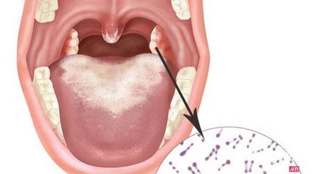 Tìm hiểu và vắc xin phòng bệnh Bạch hầu