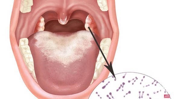 Dấu hiệu bệnh bạch hầu có dễ nhận biết?