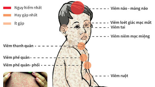 Số ca mắc sởi tăng cao trong 3 tháng đầu năm 2024