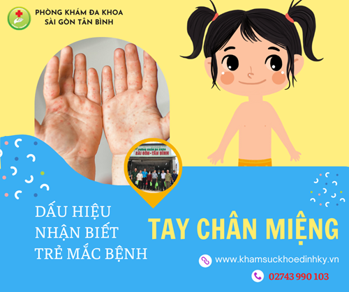 Dấu hiệu cảnh báo trẻ bị tay chân miệng