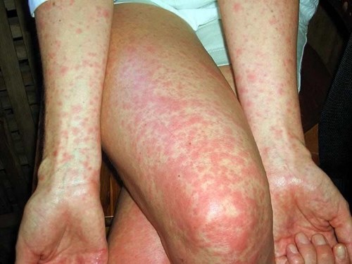 Bệnh sởi: Nguyên nhân, lây truyền, triệu chứng và cách điều trị