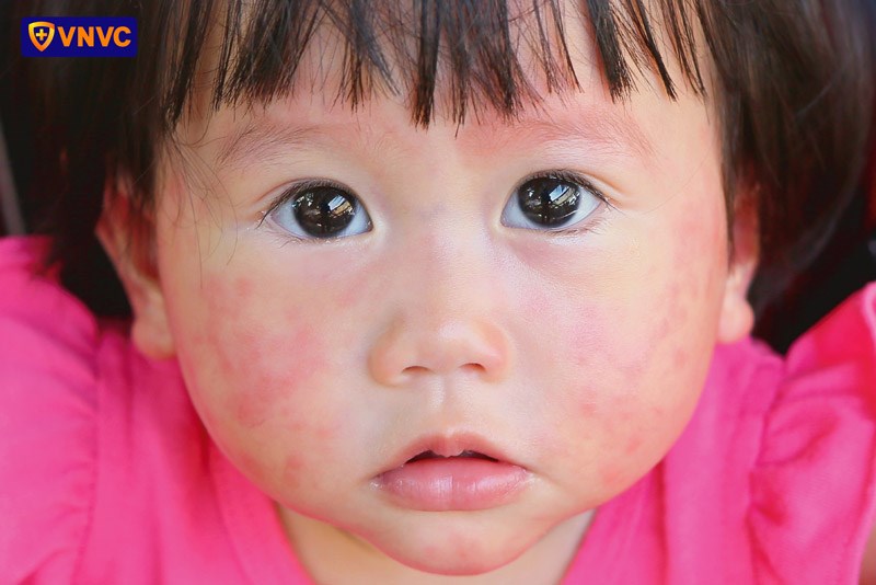 Sốt xuất huyết: Kết hợp các biện pháp để tăng hiệu quả phòng bệnh.
Theo Tổ chức Y tế thế giới (WHO), trong năm 2023 và 2024, tình trạng biến đổi khí hậu với hiện tượng El Nino có thể thúc đẩy muỗi sinh sản và làm gia tăng các bệnh truyền nhiễm do muỗi như sốt xuất huyết. Đặc biệt trong những ngày gần đây, thời tiết nắng nóng kết hợp cùng mưa giông tạo điều kiện rất tốt cho sự phát triển của muỗi truyền bệnh sốt xuất huyết.