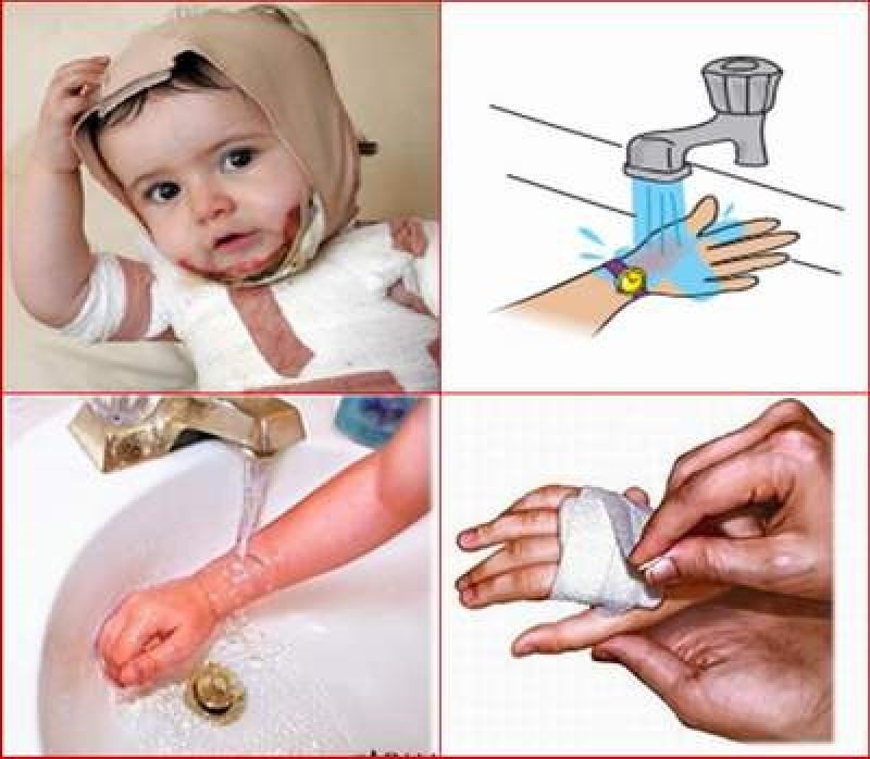 Sơ cứu khi bị bỏng