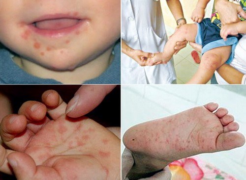 Hãy chủ động phòng bệnh Tay Chân Miệng