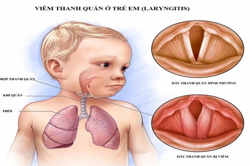 Viêm khí phế quản, biến chứng viêm phổi