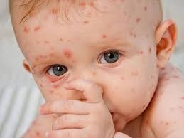 Bệnh sởi đi ngược với “truyền thống  có nguy hiểm hơn không?