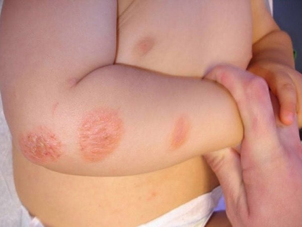 Bệnh về da trẻ thường gặp trong mùa nắng nóng