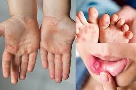 Phòng chống bệnh Tay Chân Miệng cho trẻ