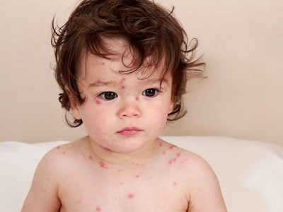 Những điều cần biết về bệnh thủy đậu