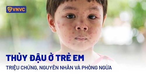 Bệnh Thủy đậu ở Trẻ em