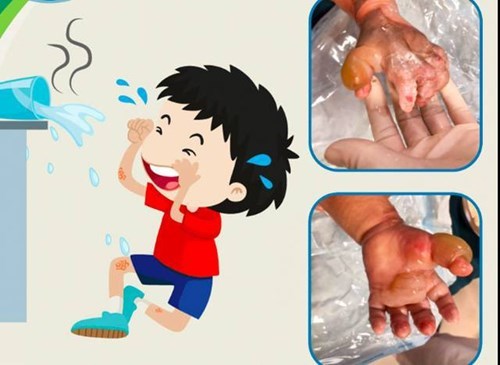 Con bị bỏng, cha mẹ vô tình làm hại con chỉ vì nghe lời người quen