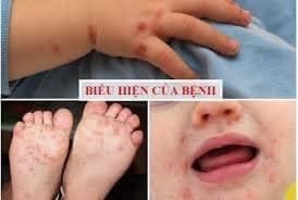 Nguyên nhân- Triệu chứng bệnh Tay Chân Miệng