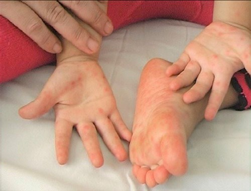 Các bệnh thường gặp ở trẻ dưới 3 tuổi
