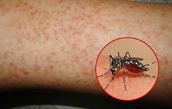 Các biện pháp phòng bệnh sốt xuất huyết
