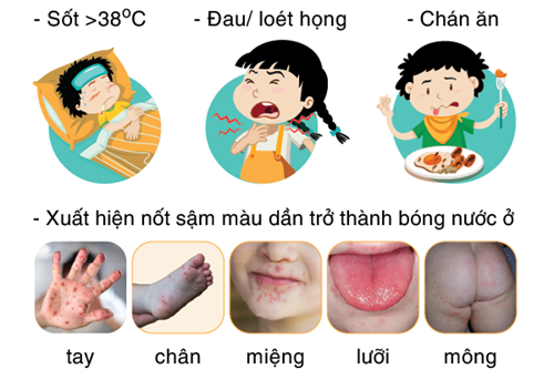Một số biện phát phòng bệnh tay chân miệng tại trường mầm non