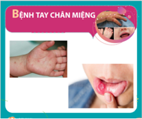 Bệnh Tay chân miệng - Cách phòng bệnh và chăm sóc cho trẻ